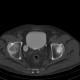 Diverticulum of urinary bladder, excretory phase: CT - Computed tomography